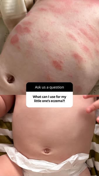 Soothe Itchy, Red Skin