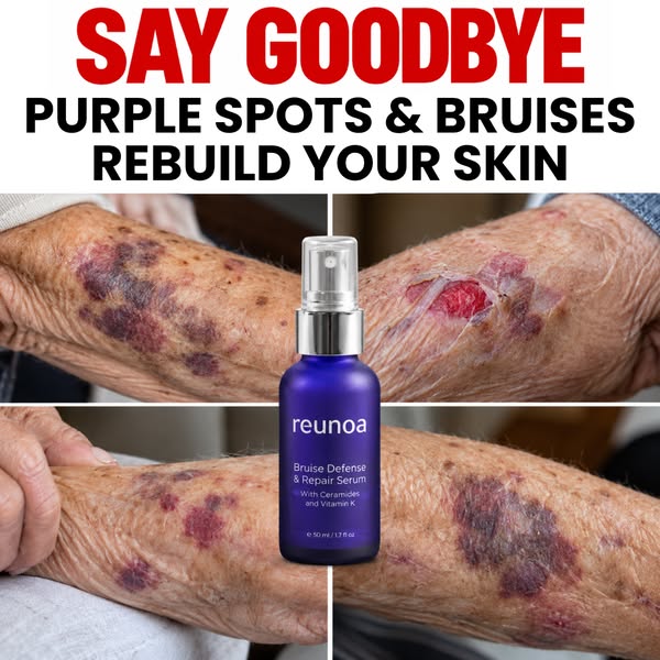 Bruises Gone In Days!