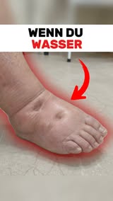 Schwellungen natürlich lindern
