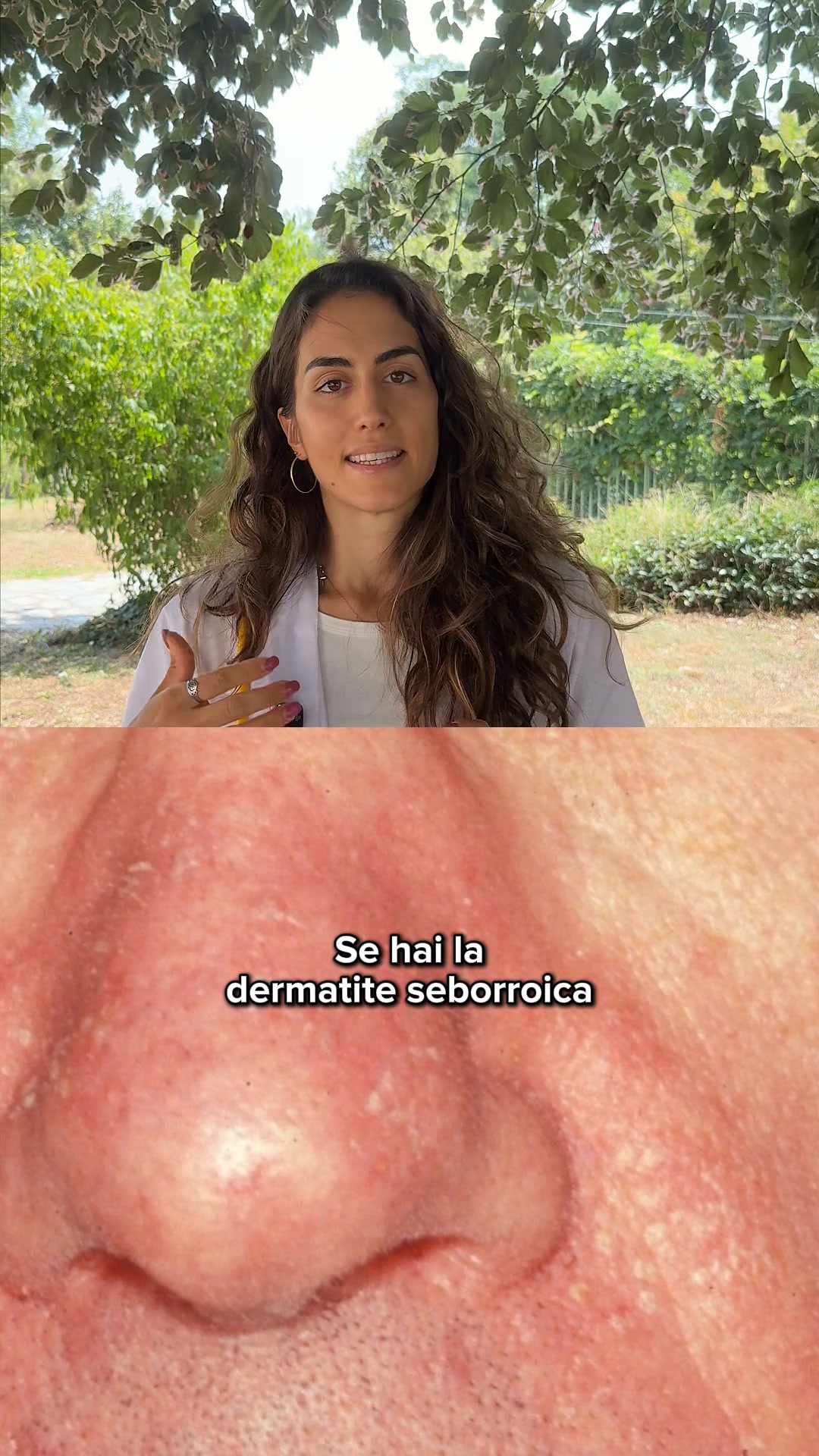 Supporto naturale per la tua Dermatite Seborroica