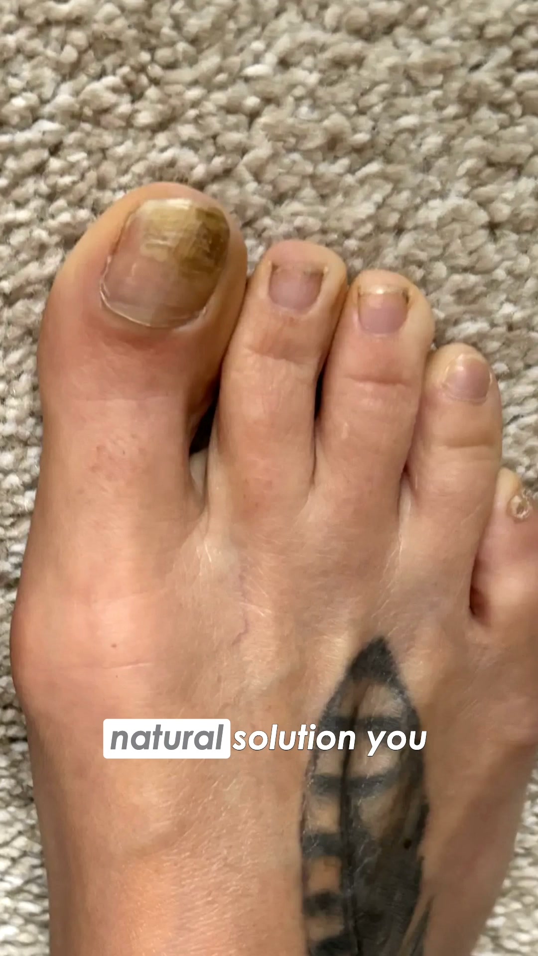 Fungal Nails? Find The Cause
