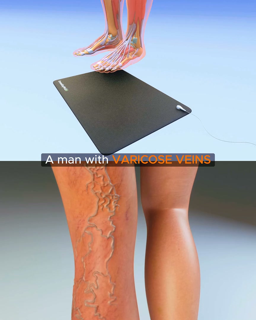 Natural Varicose Veins Relief