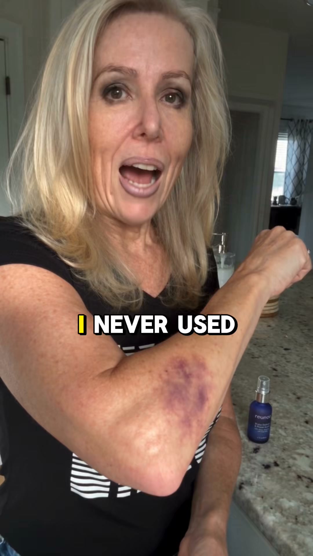 Bruises Gone In Days!