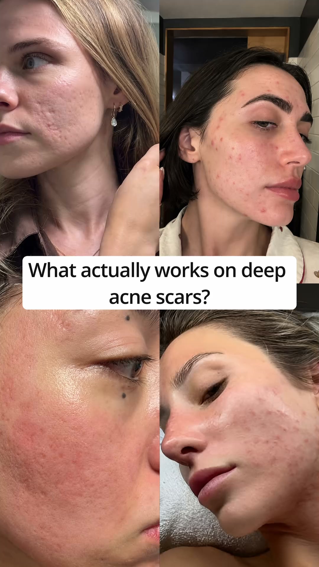 Fastest Way To Fade Acne Scars