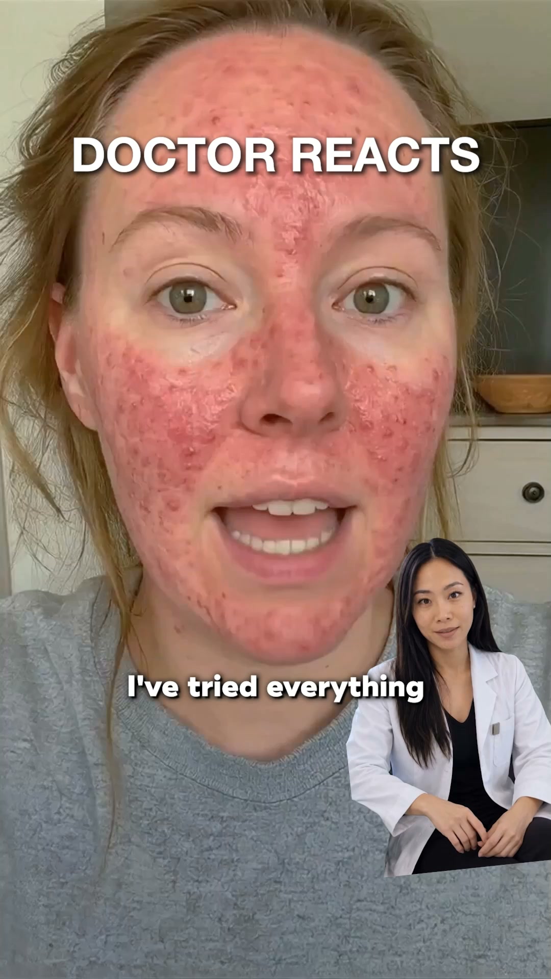 The Rosacea Myth: The Real Reason Flare-Ups Keep Coming Back