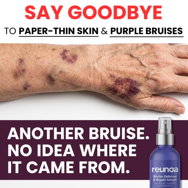 Bruises Gone In Days!