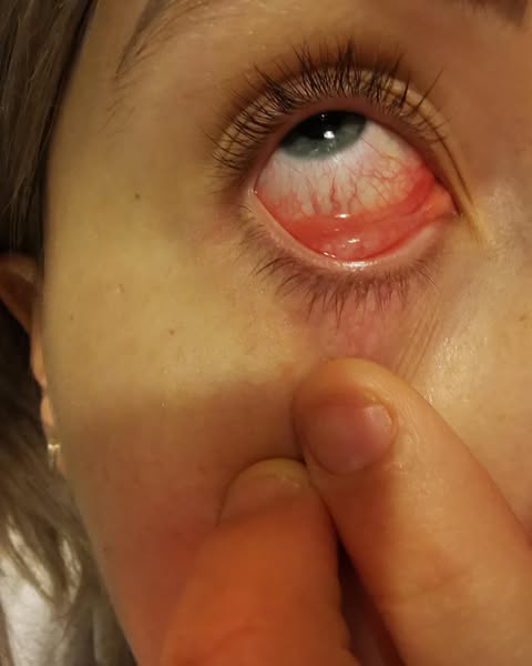 I Was Diagnosed With IIH At 32 After A Spinal Tap. I'm 40 Now. My Neuro-Ophthalmologist Never Asked Me About The Headaches I Had Before The