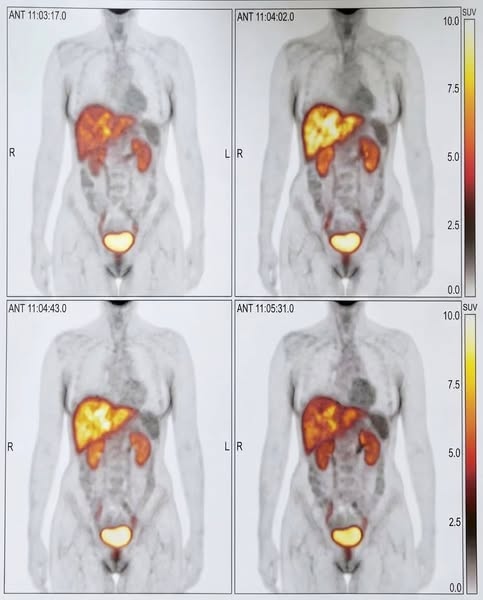 Fatty Liver? It's Not About Your Weight...