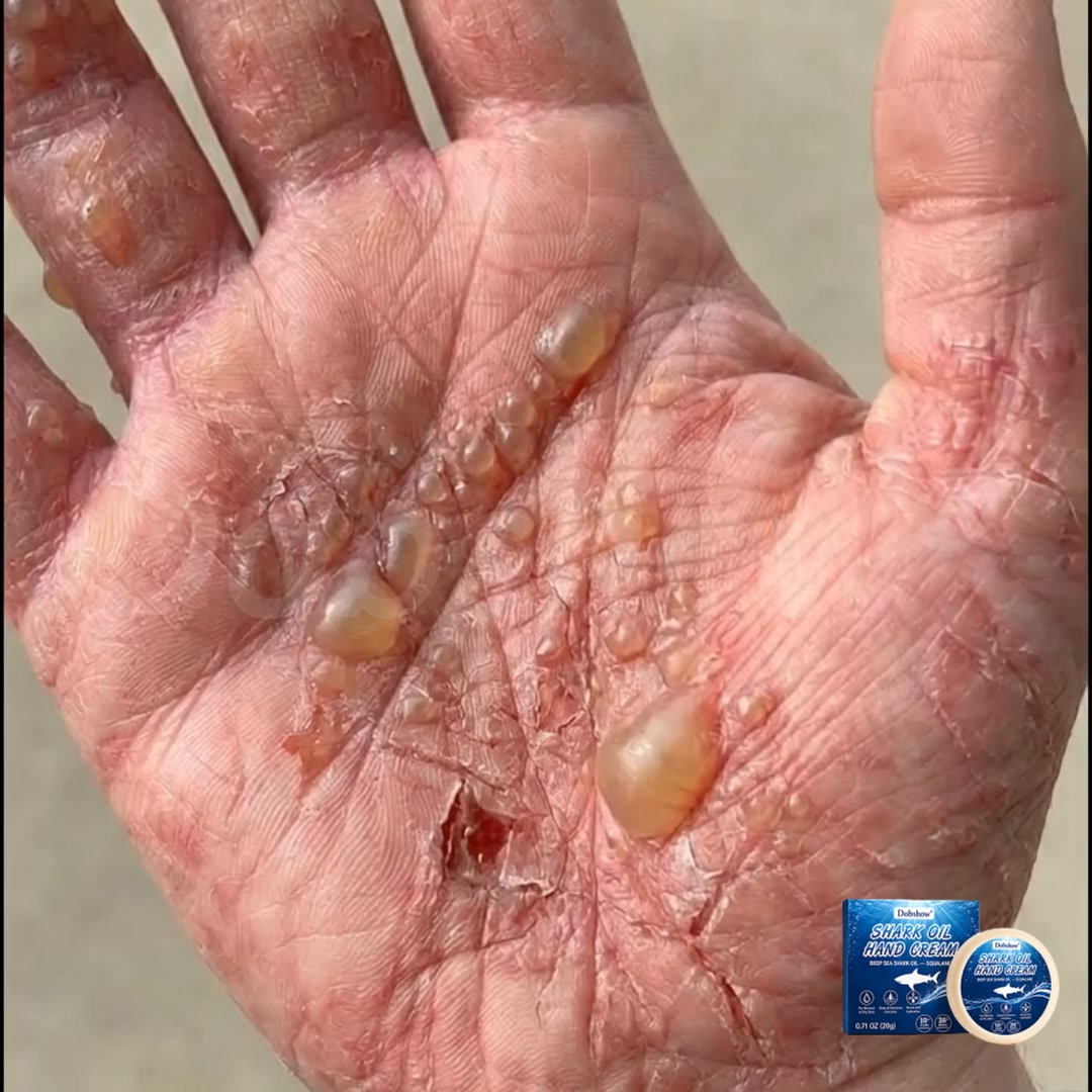 Stop Dyshidrotic Eczema & Hand Tinea Fast