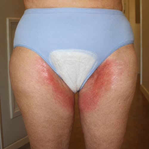 After menopause, bladder leakage isn't a muscle problem.