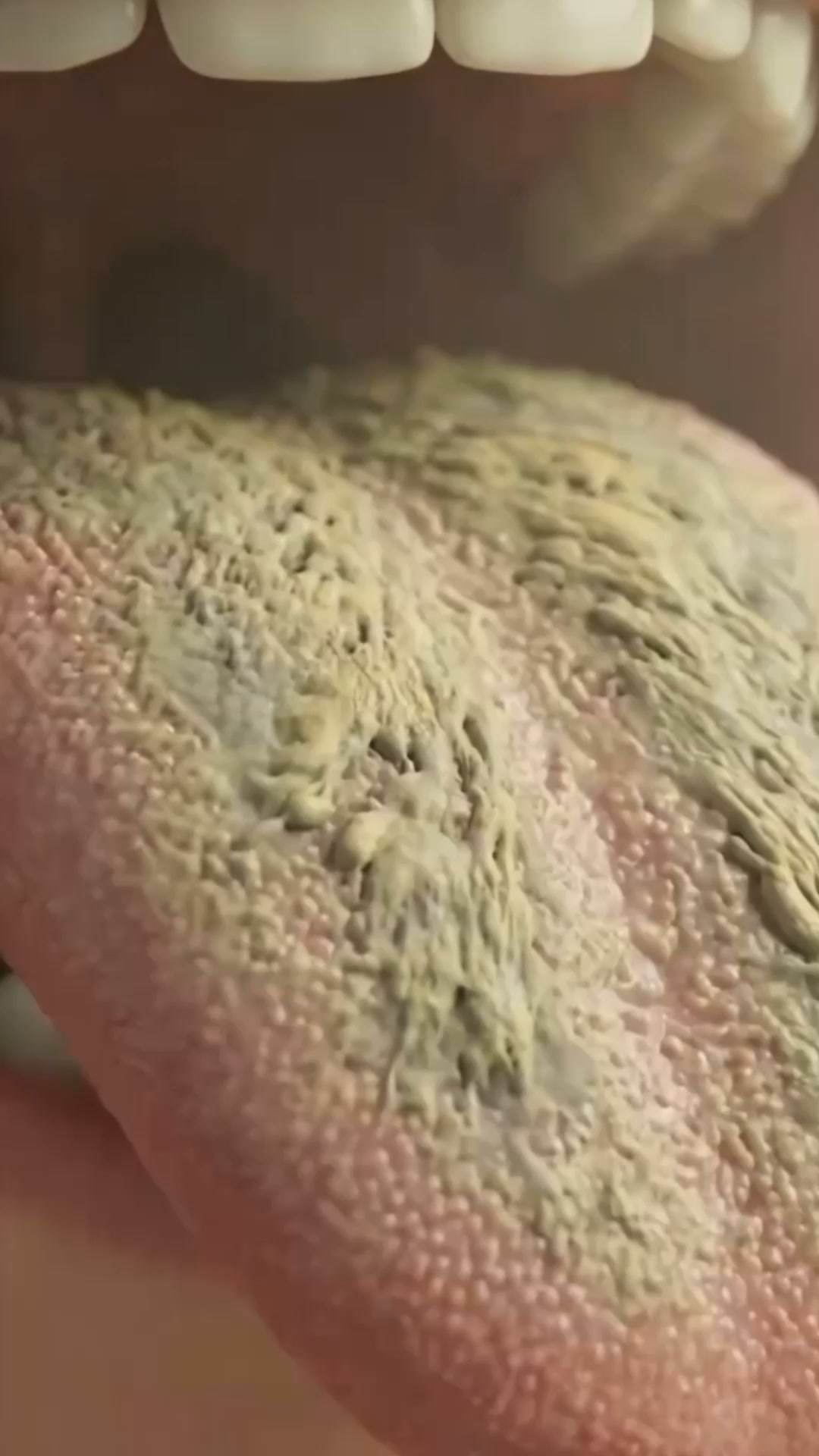 Relief for Every Tongue Trouble — Naturally in Days