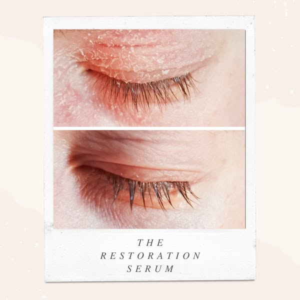 Fast Relief From Blepharitis