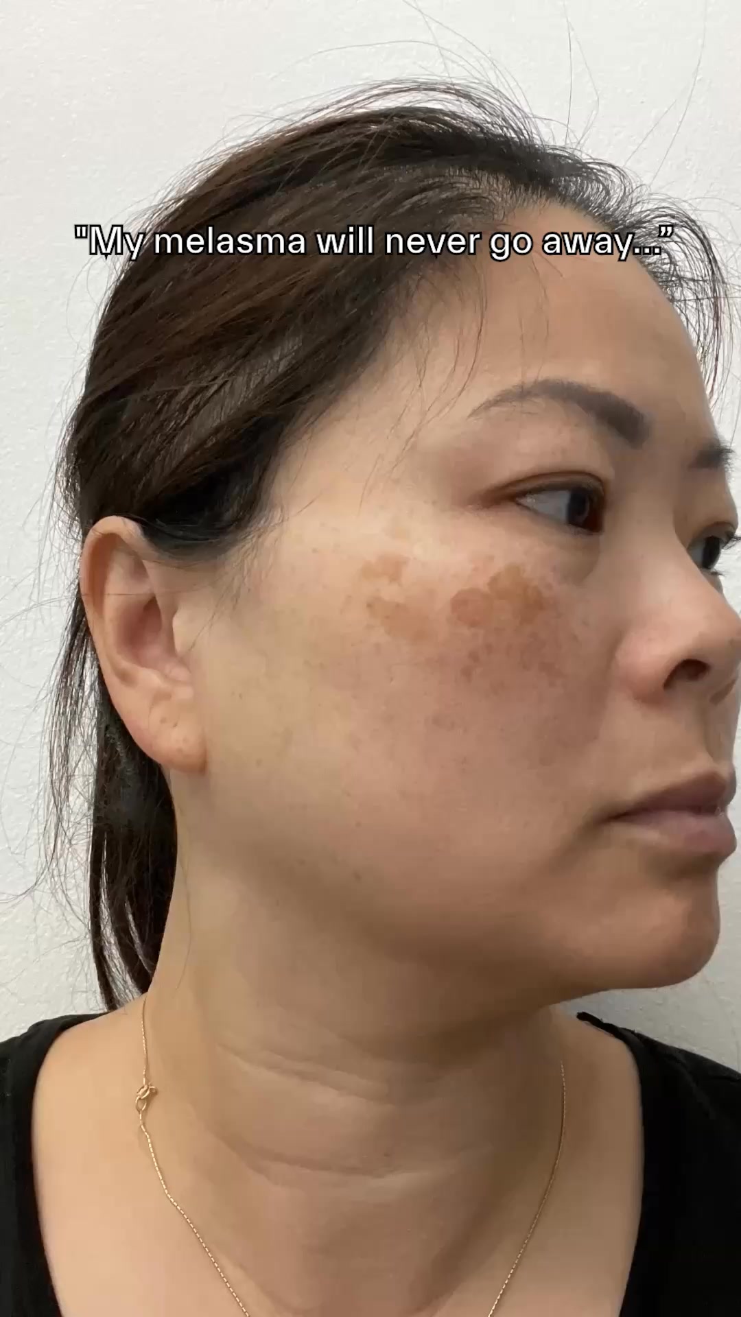 Treat melasma with a retinoids formula