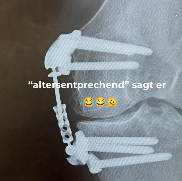 Der wahre Grund, warum über 70 % aller Frauen in den Wechseljahren plötzlich Gelenkschmerzen entwickeln.