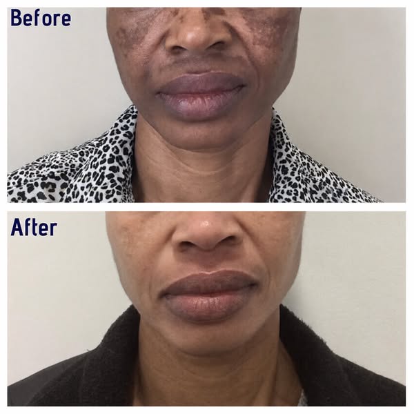 For The Dark Spots That Refuse To Budge