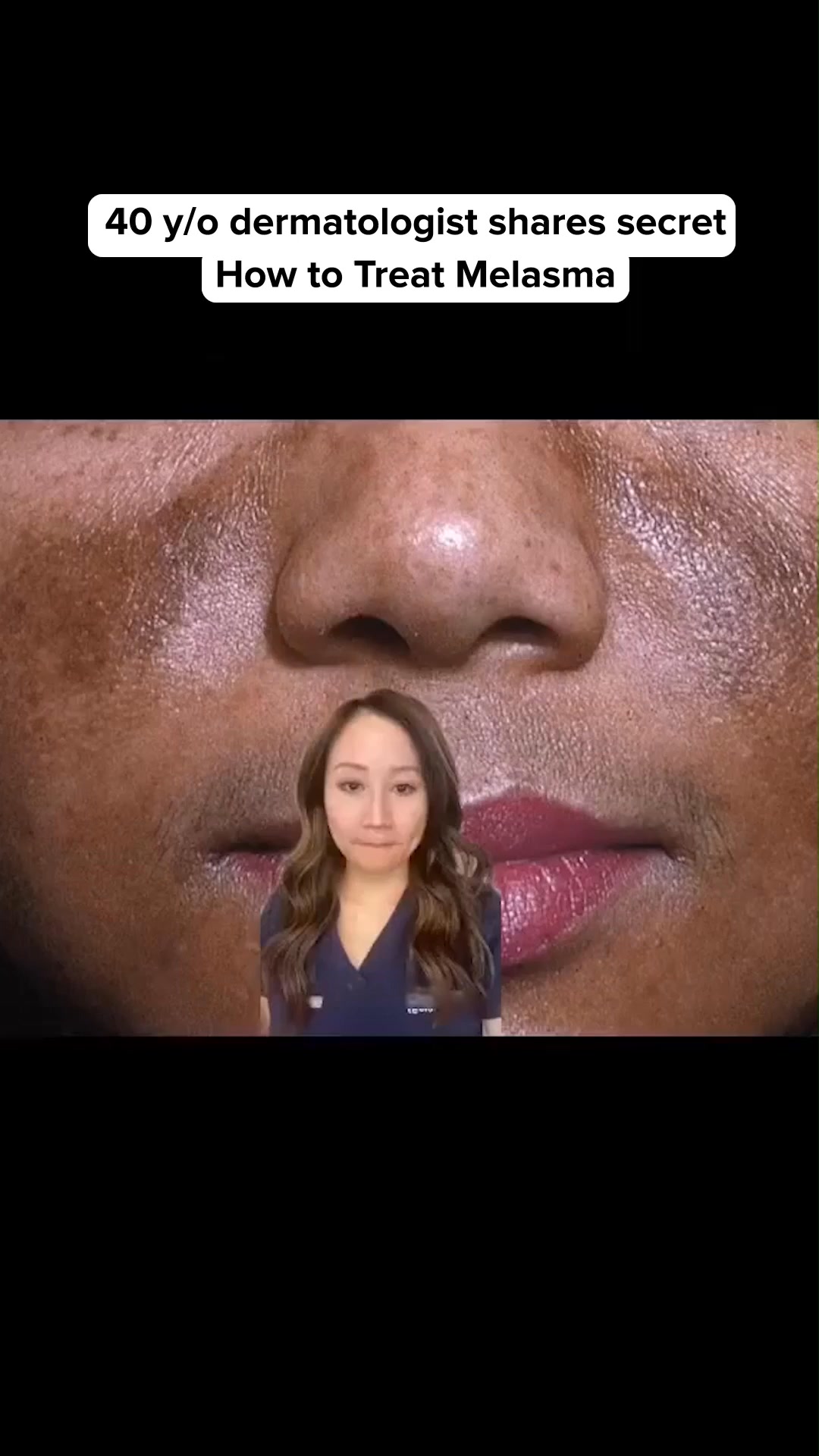 The Melasma Myth: Why Dark Patches Keep Coming Back
