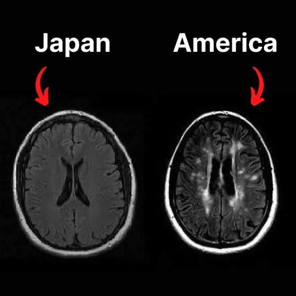 The Japanese MS Research No American Doctor Is Taught