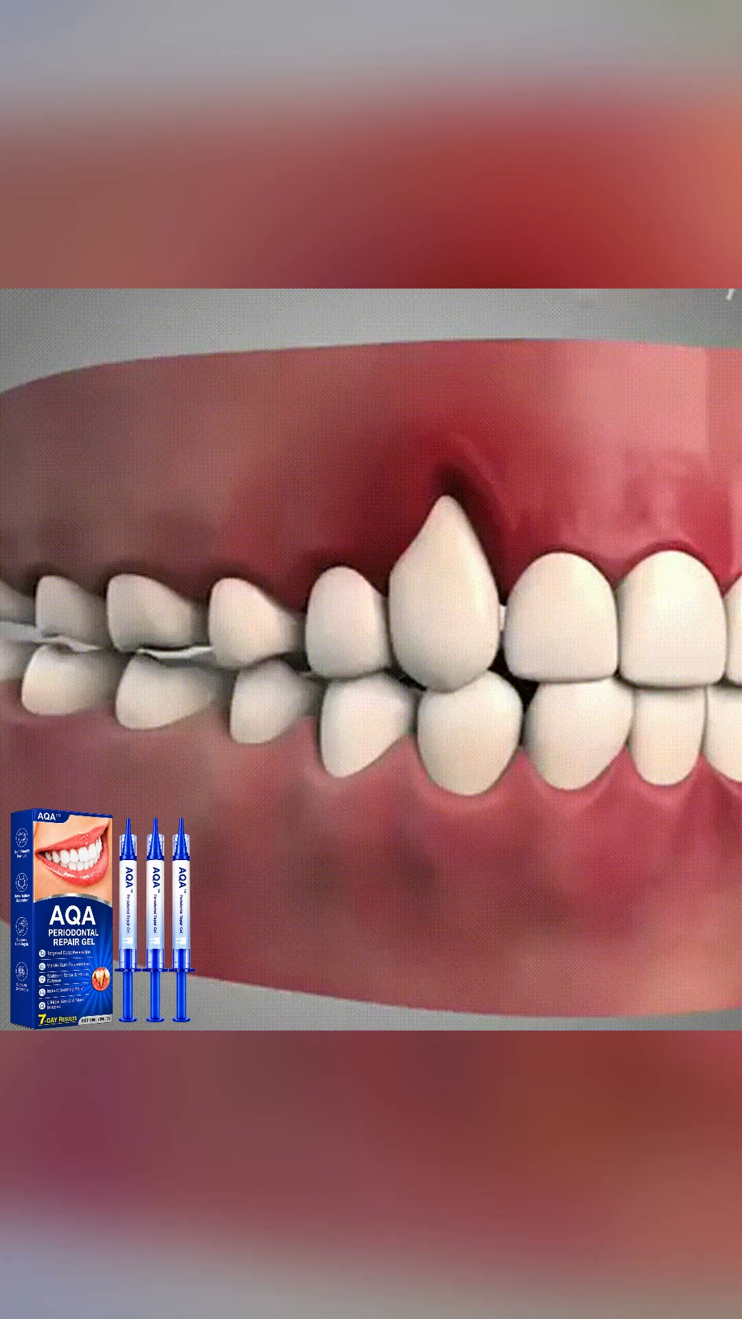 FDA-approved gum regeneration therapy