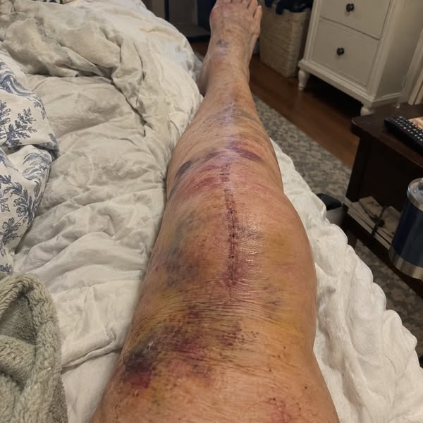 Read If Knee Pain After Replacement