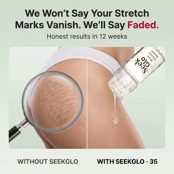 Stretch Marks? Try This At Home
