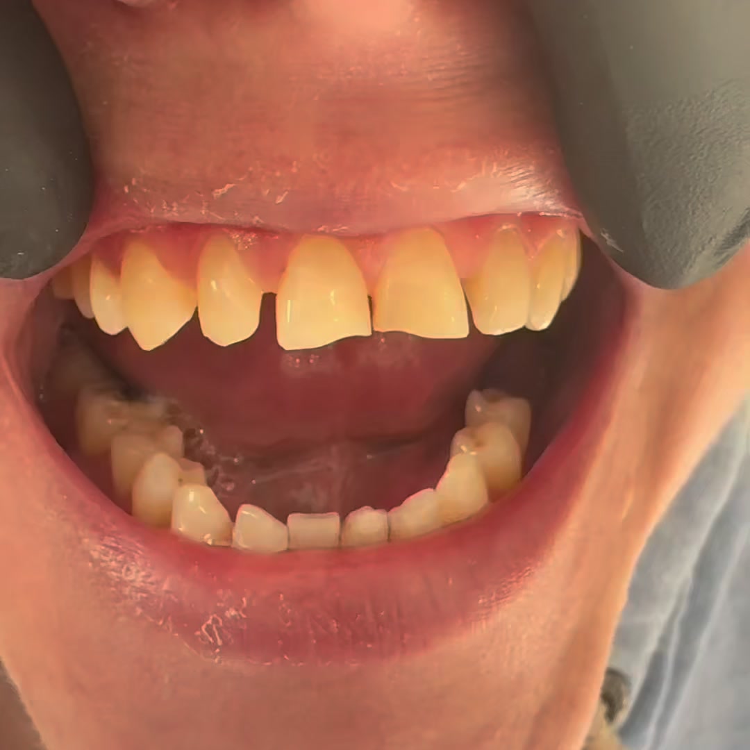 3,400 Patients. Zero Turkey Teeth. Here Is How We Do Composite Bonding Differently.