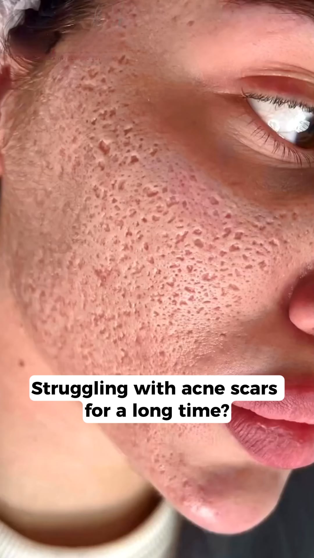Fastest Way To Fade Acne Scars