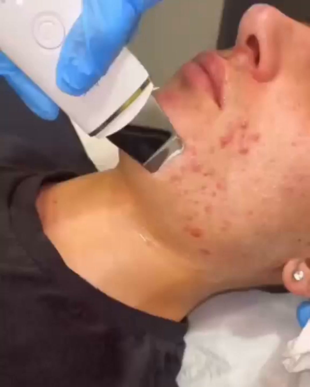 Stop Acne - Bespaar 50%