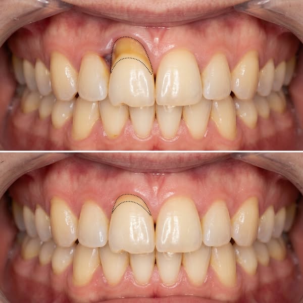Read this if your gums are receding