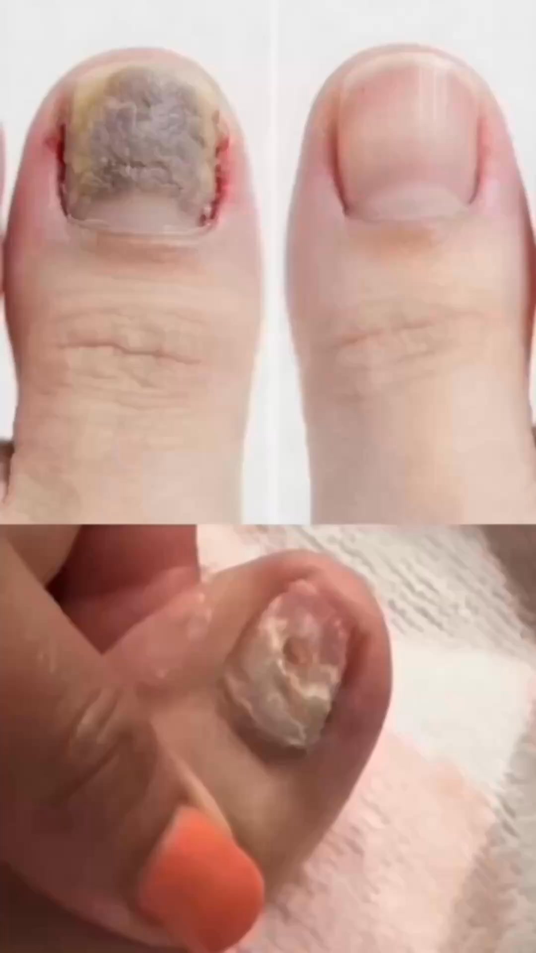 Le patch de nuit qui agit sous l’ongle