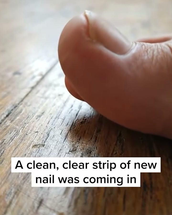 I Wasted Years on Creams That Failed