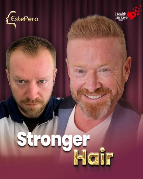 Best Hair Transplant Turkey 2026 - Estepera Clinic