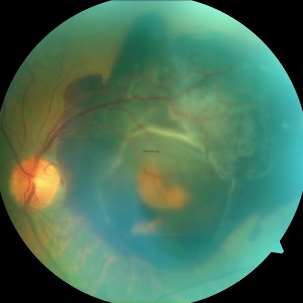 Fight Back Against Macular Degeneration!