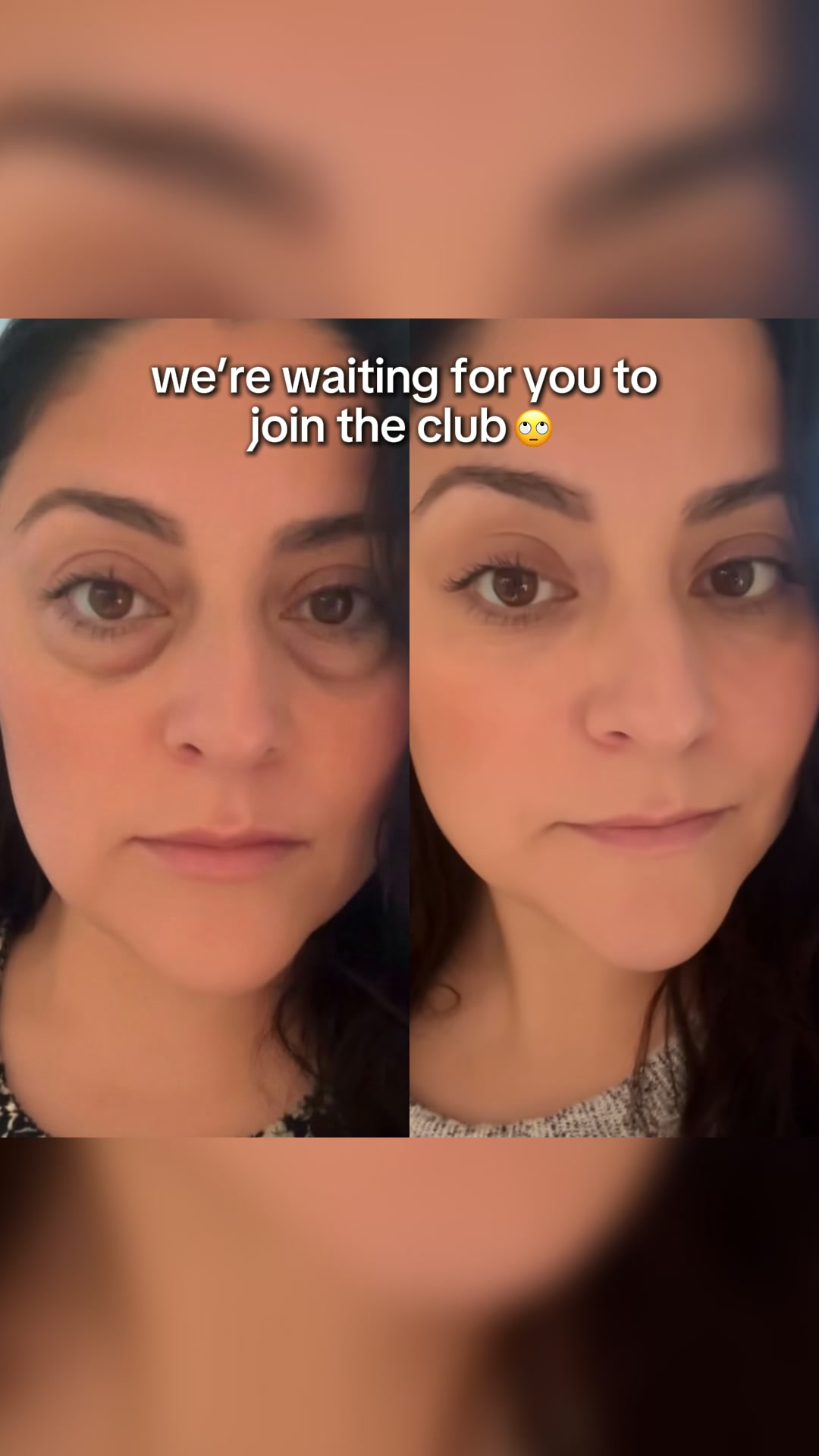 The fastest, proven way to erase eye bags and dark circles