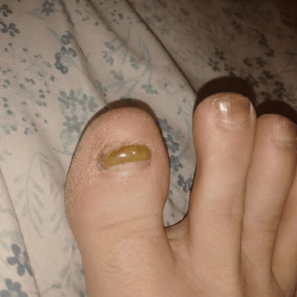 A mycologist told me why nothing works for toenail fungus