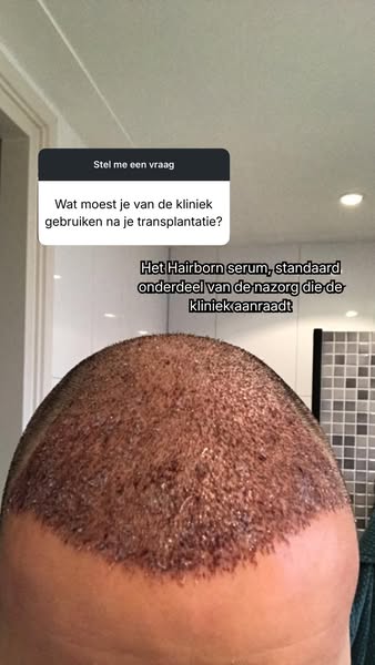 Ook na een haartransplantatie blijft haarverzorging belangrijk
