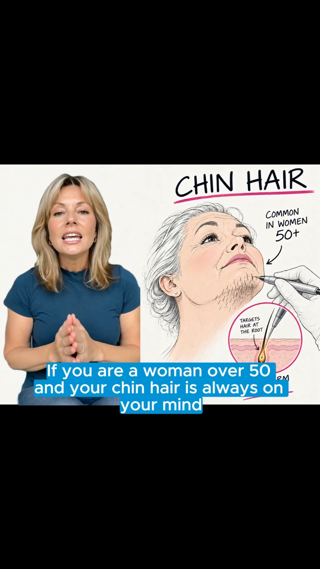 Still Dealing With Stubborn Chin Hair?