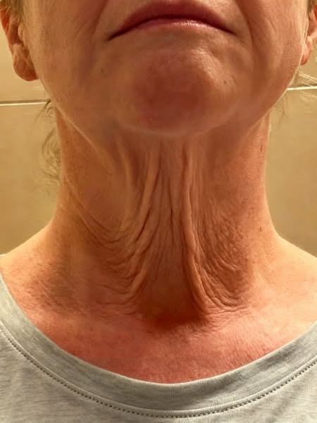 My client Karen's neurologist recommended Botox for her head tremors. Every three months. Indefinitely. She asked me what she was actually a