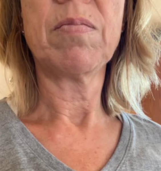 My answer for the saggy skin Ozempic left behind + my husband finally noticing my face again