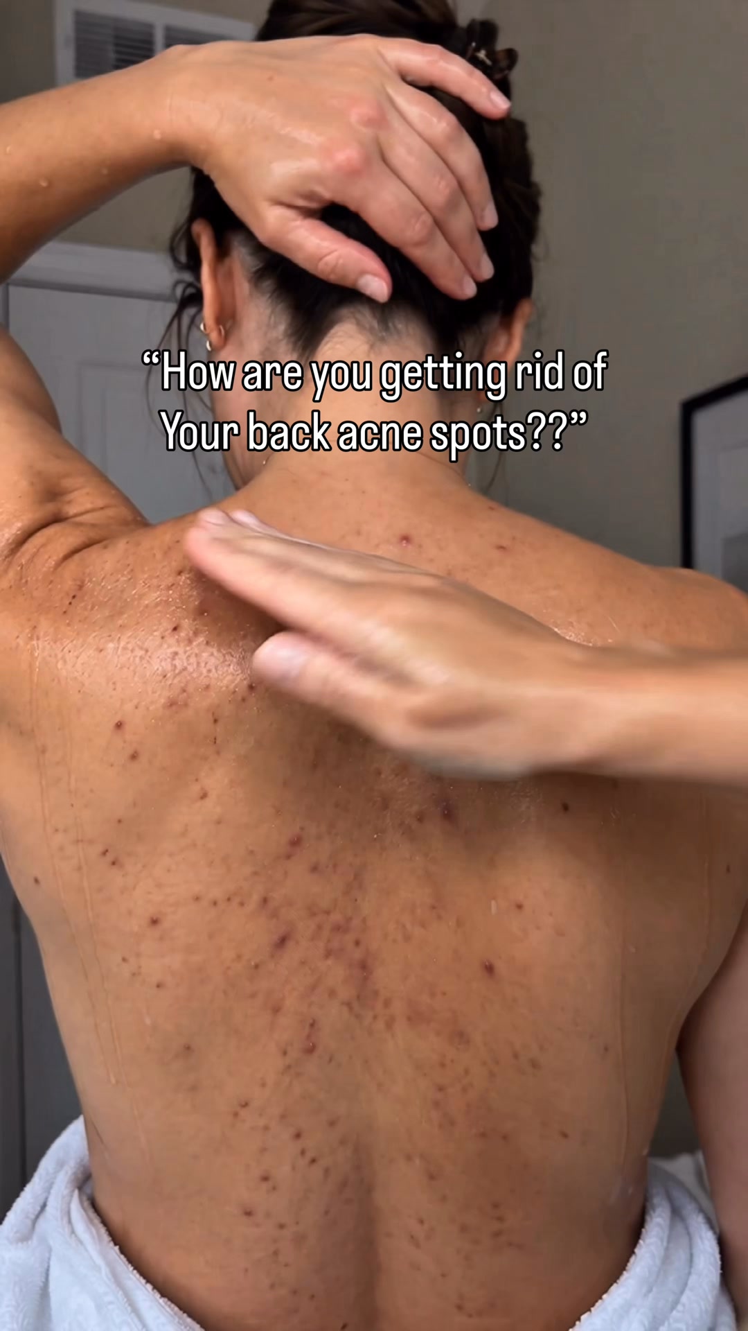 Clear Acne Spots In 2 weeks