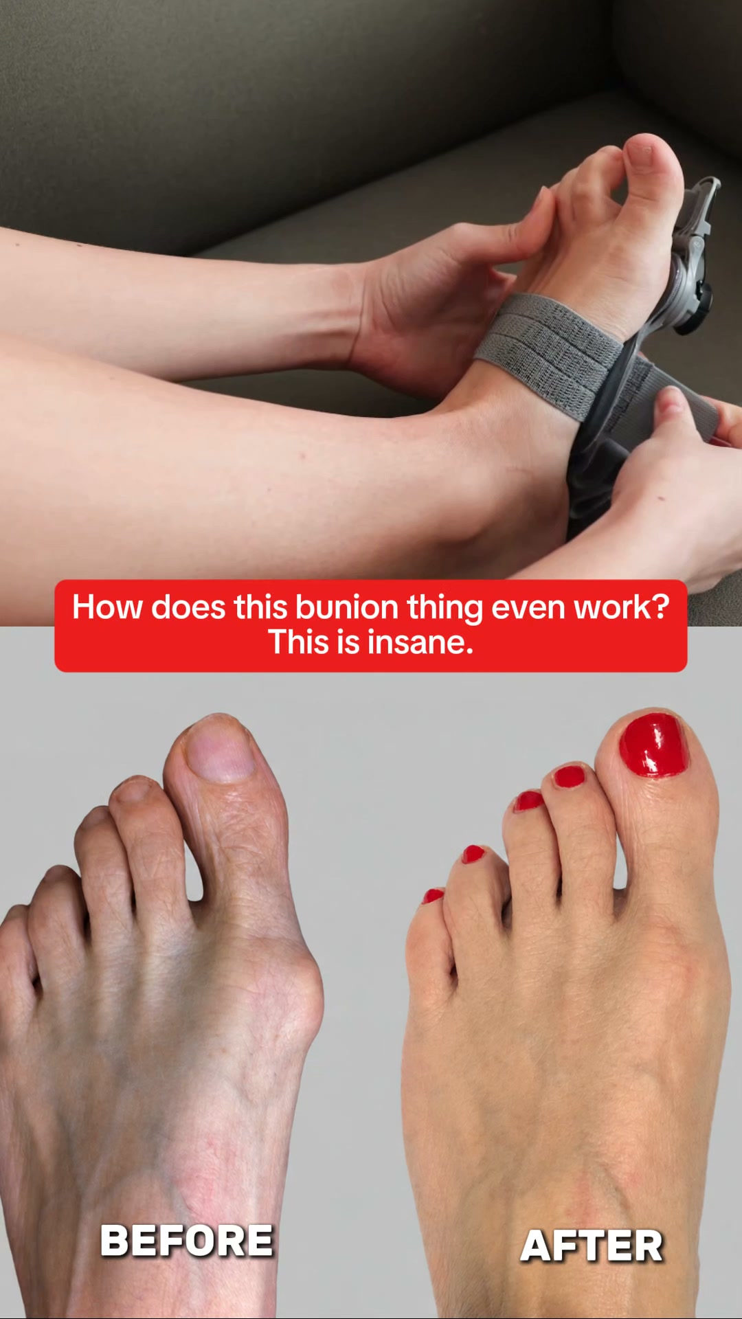 Fix Your Bunions Without Surgery