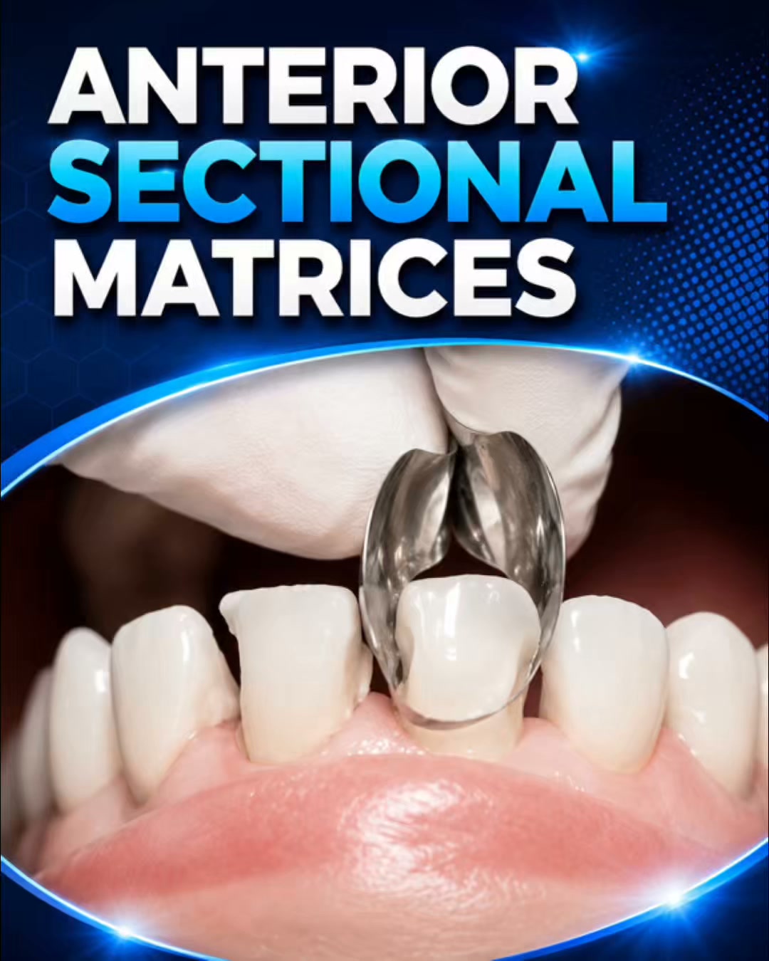Anterior Sectional Matrices —Natural Contours. Less Finishing Time.