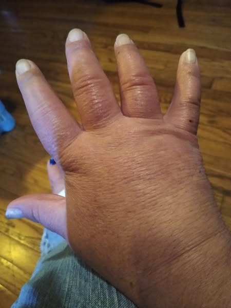 Women with arthritis: your heart is next