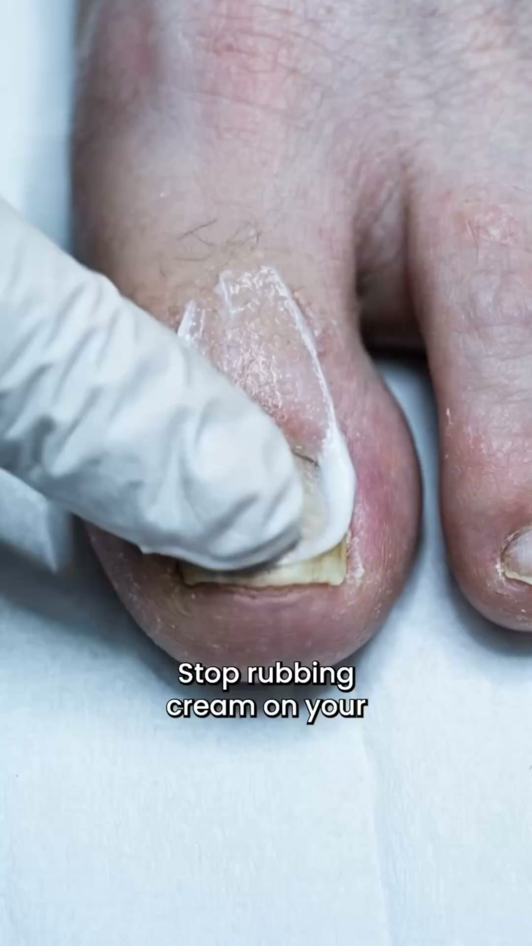 Elimina el hongo desde la raíz