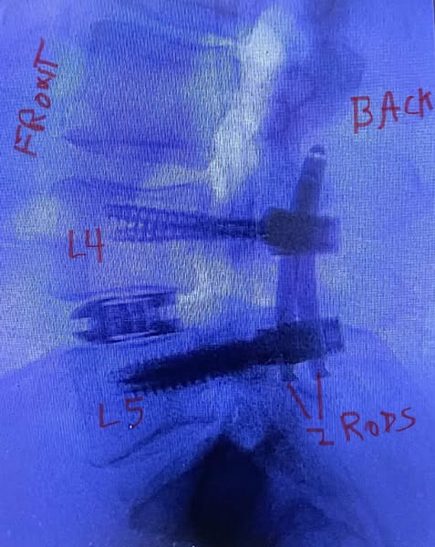 The Real reason your sciatica keeps coming back.