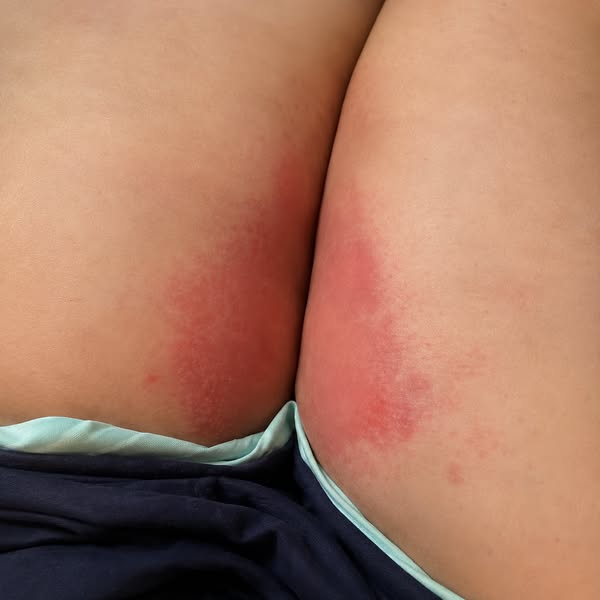 If you have a Skin Fold Rash problem, you need to read this