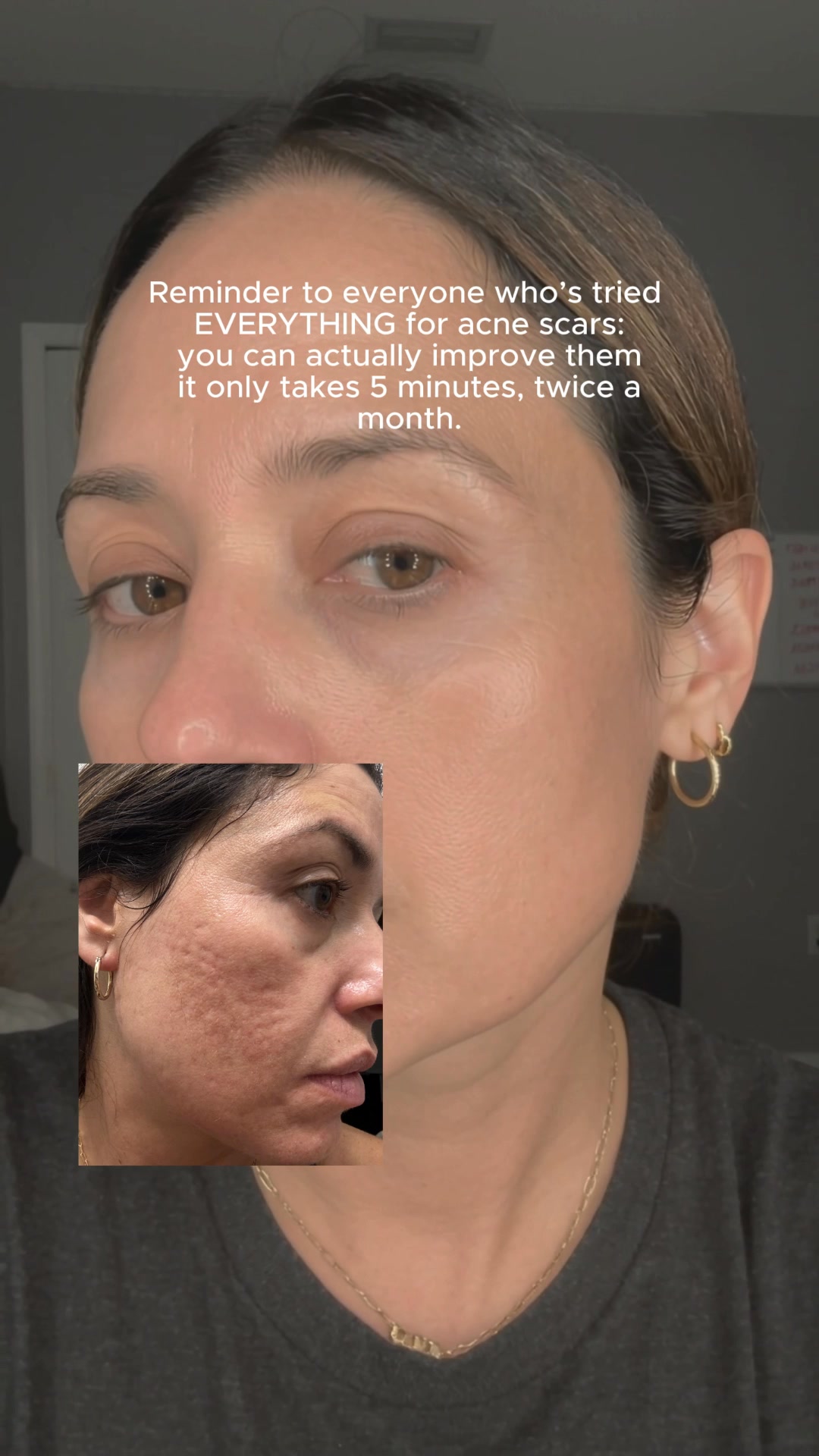 The DNA Repair Hack for Acne Scars