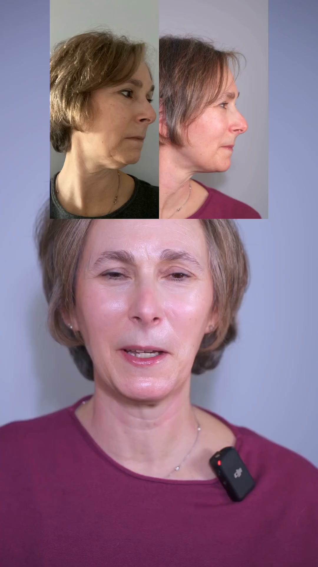 Hooded eyes, Smile lines, Jowls, Eye bags, Double chin