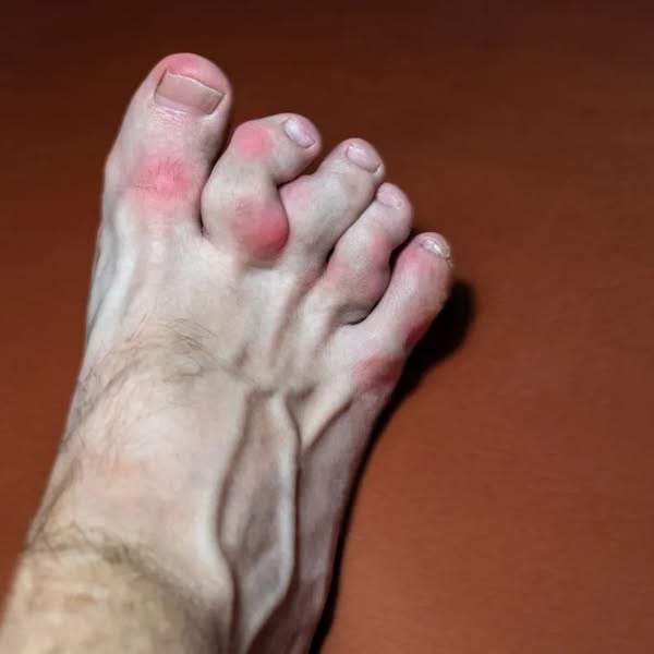 People With Gout Are 3.4x More Likely To Die From Kidney Failure Before 70
