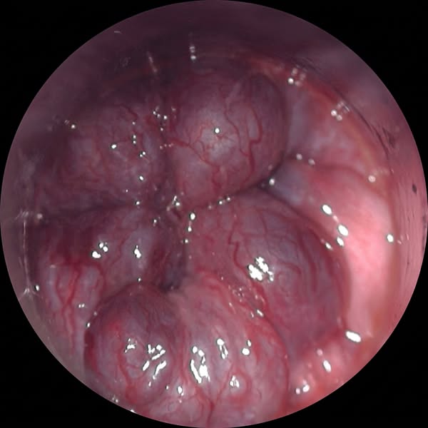 Hemorrhoids? Read this...
