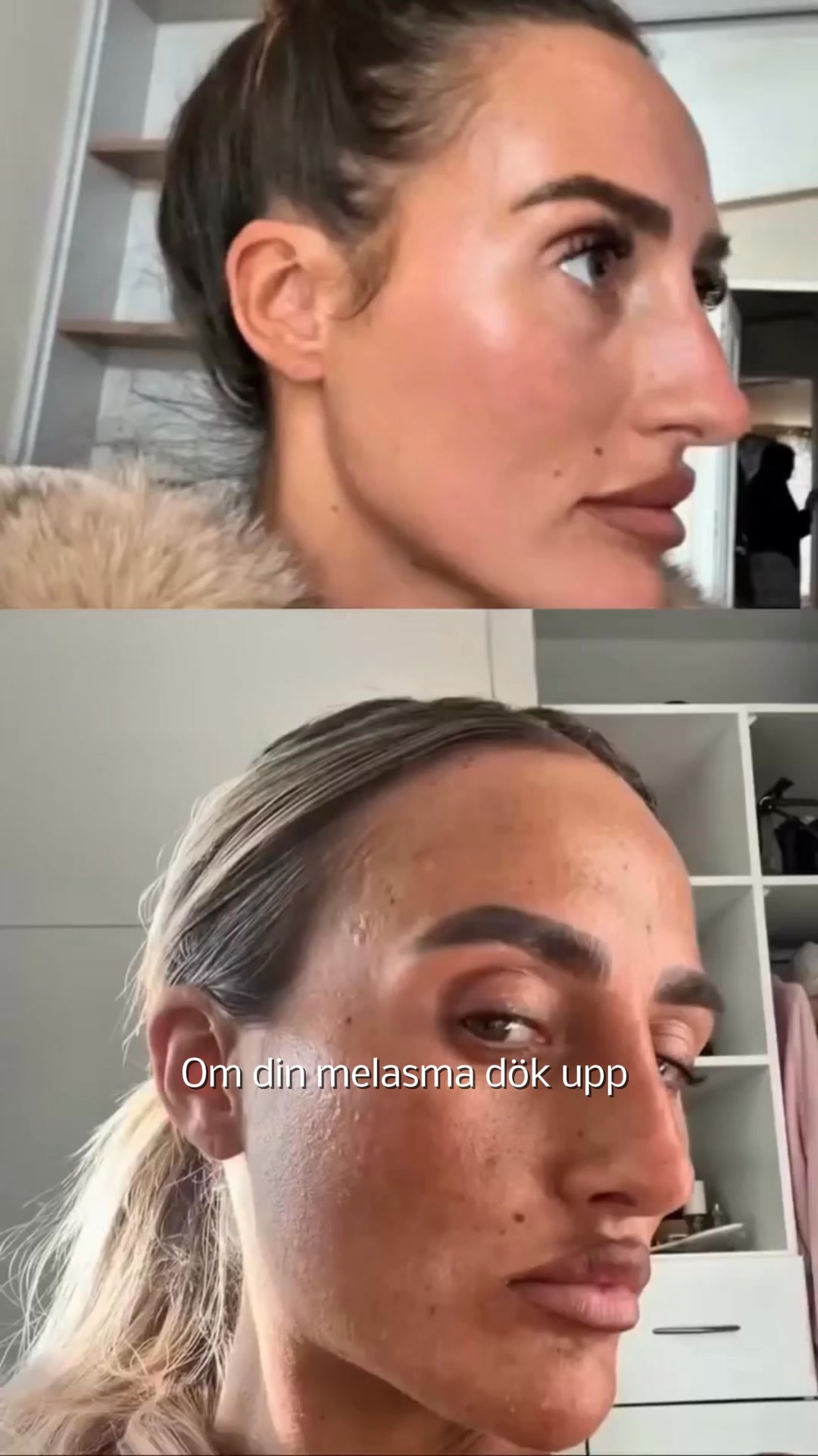 Äntligen förstår jag varför ingenting har hjälpt mot mina pigmentfläckar
